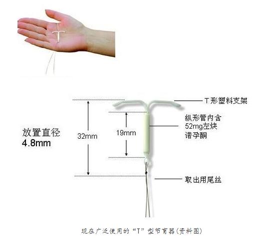 女性被逼在子宫腔内上环：不人性化，对女性的摧残！