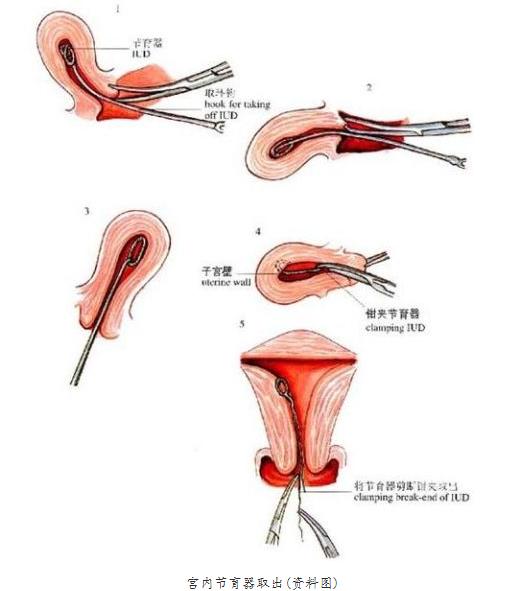 女性被逼在子宫腔内上环：不人性化，对女性的摧残！