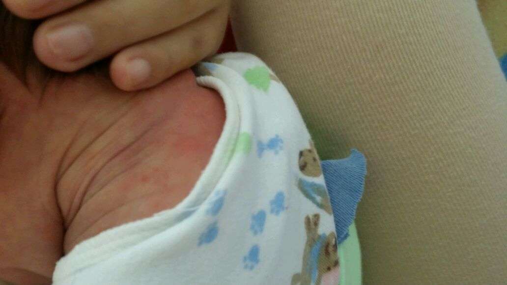 新生儿出痱子怎样能快速治好 (如何快速治好宝宝头上的痱子)