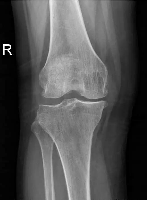 退行性骨关节炎的症状和治疗,退行性骨性关节炎分级