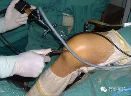 退行性骨关节炎的症状和治疗,退行性骨性关节炎分级