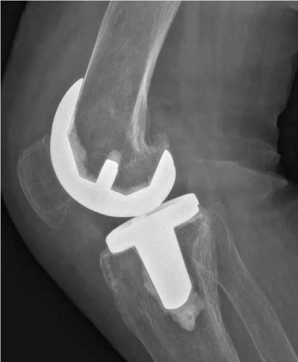 退行性骨关节炎的症状和治疗,退行性骨性关节炎分级