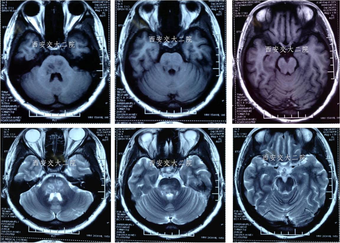介入科病例,介入手术的健康科普方案
