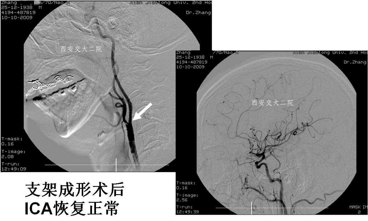 介入科病例,介入手术的健康科普方案
