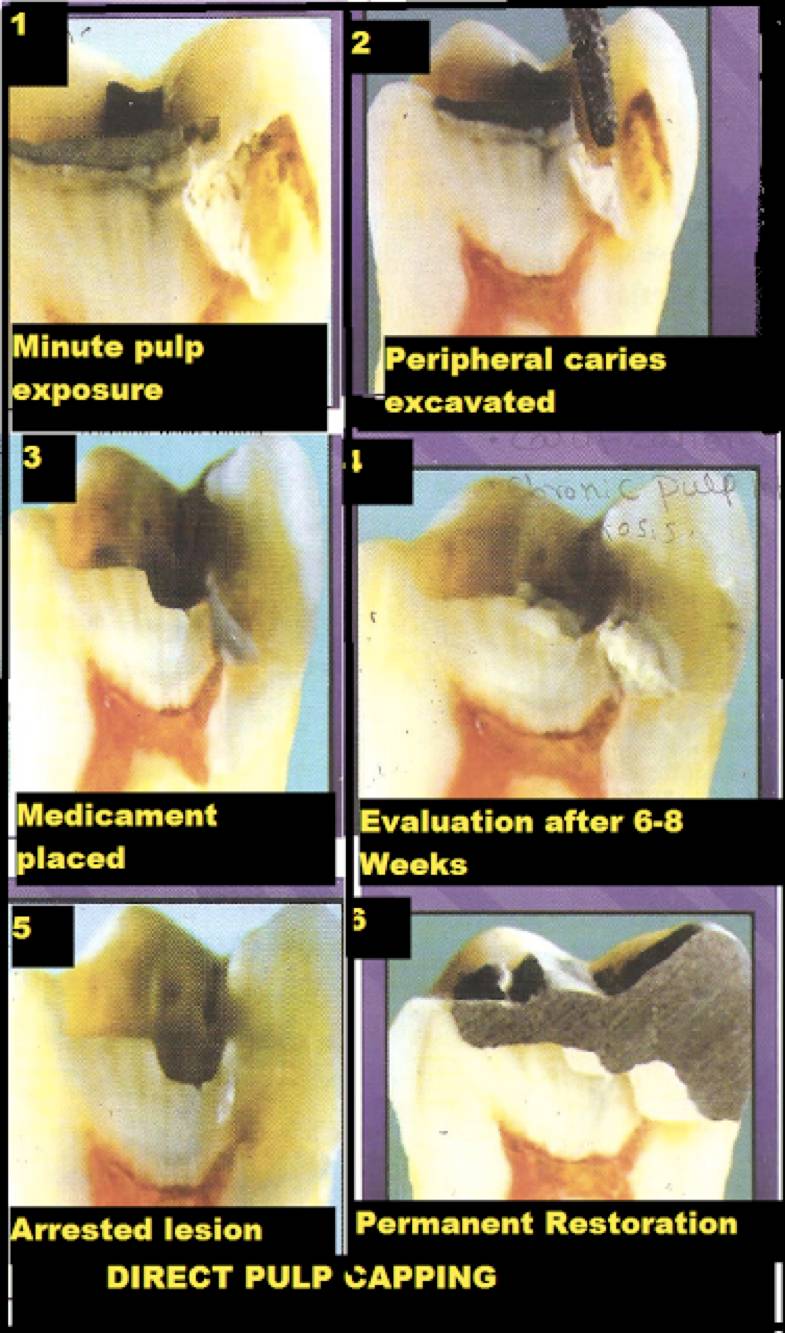 牙神经坏了根管治疗,牙神经坏了有修复的方法吗