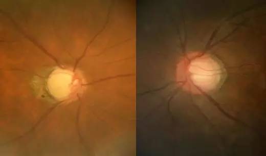 中医治疗正常眼压开角型青光眼,原发性闭角型青光眼快速降眼压