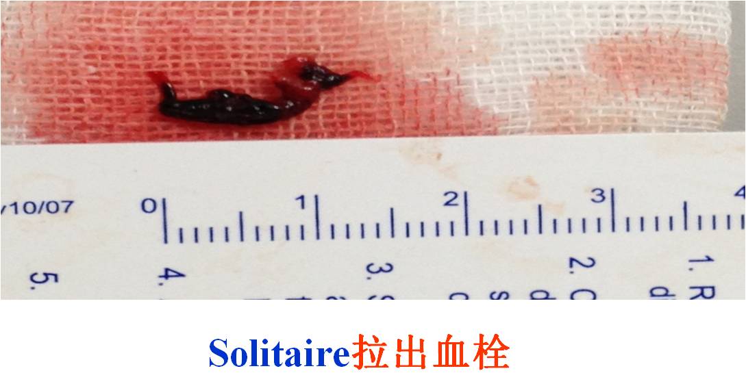 介入科病例,介入手术的健康科普方案