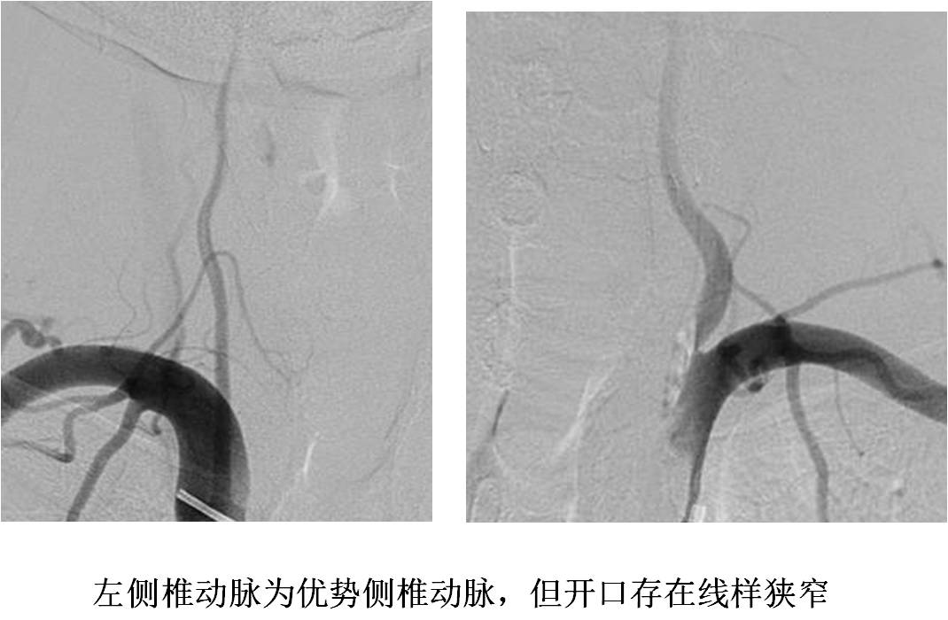 介入科病例,介入手术的健康科普方案