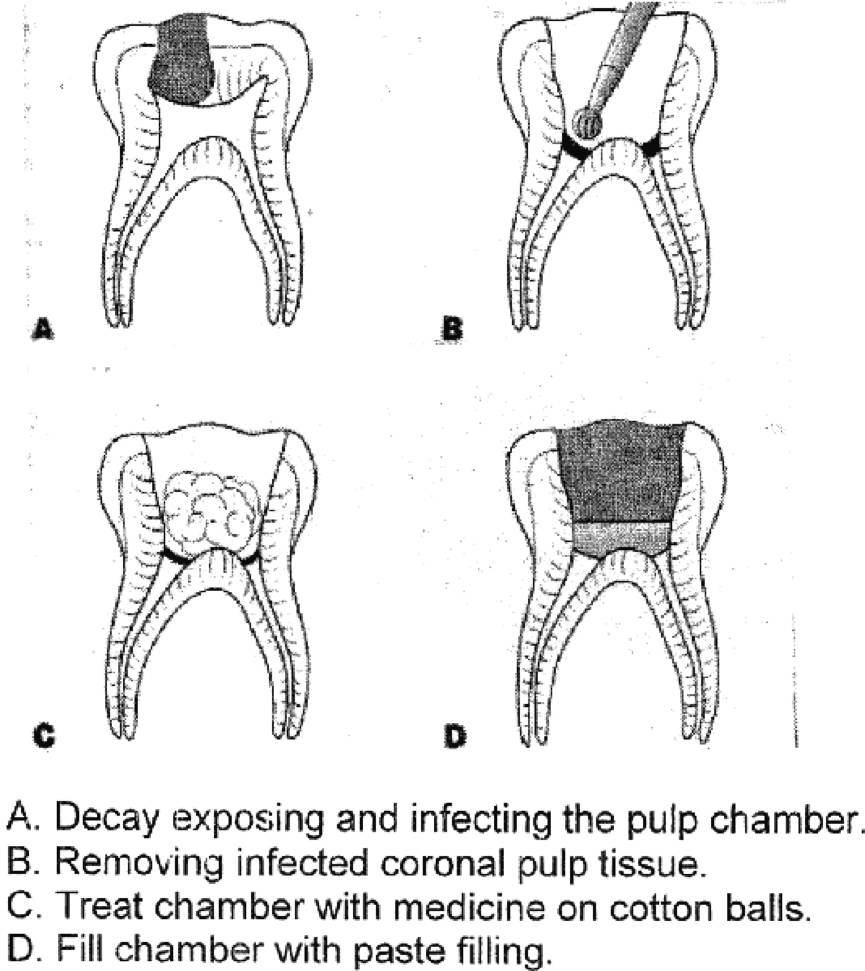 牙神经坏了根管治疗,牙神经坏了有修复的方法吗