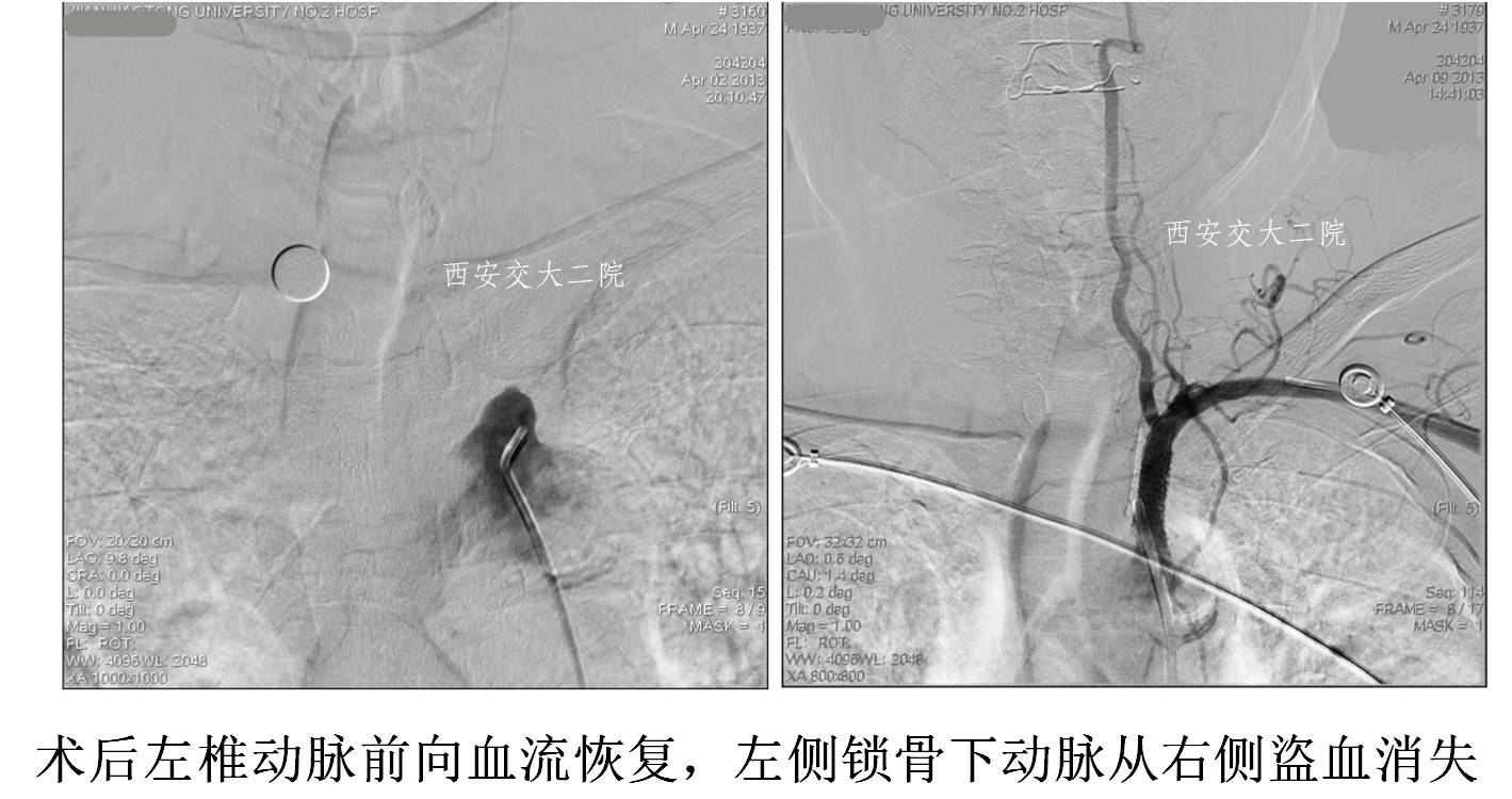 介入科病例,介入手术的健康科普方案