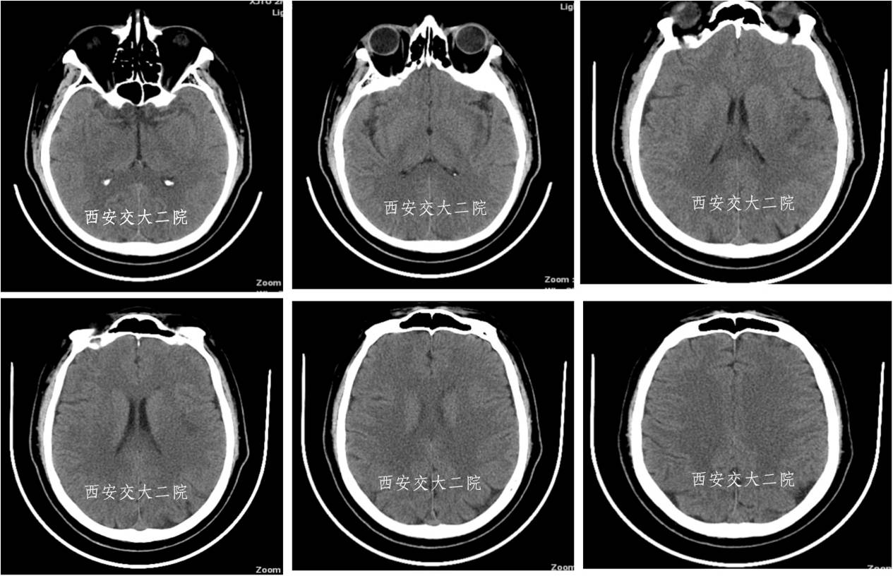 介入科病例,介入手术的健康科普方案