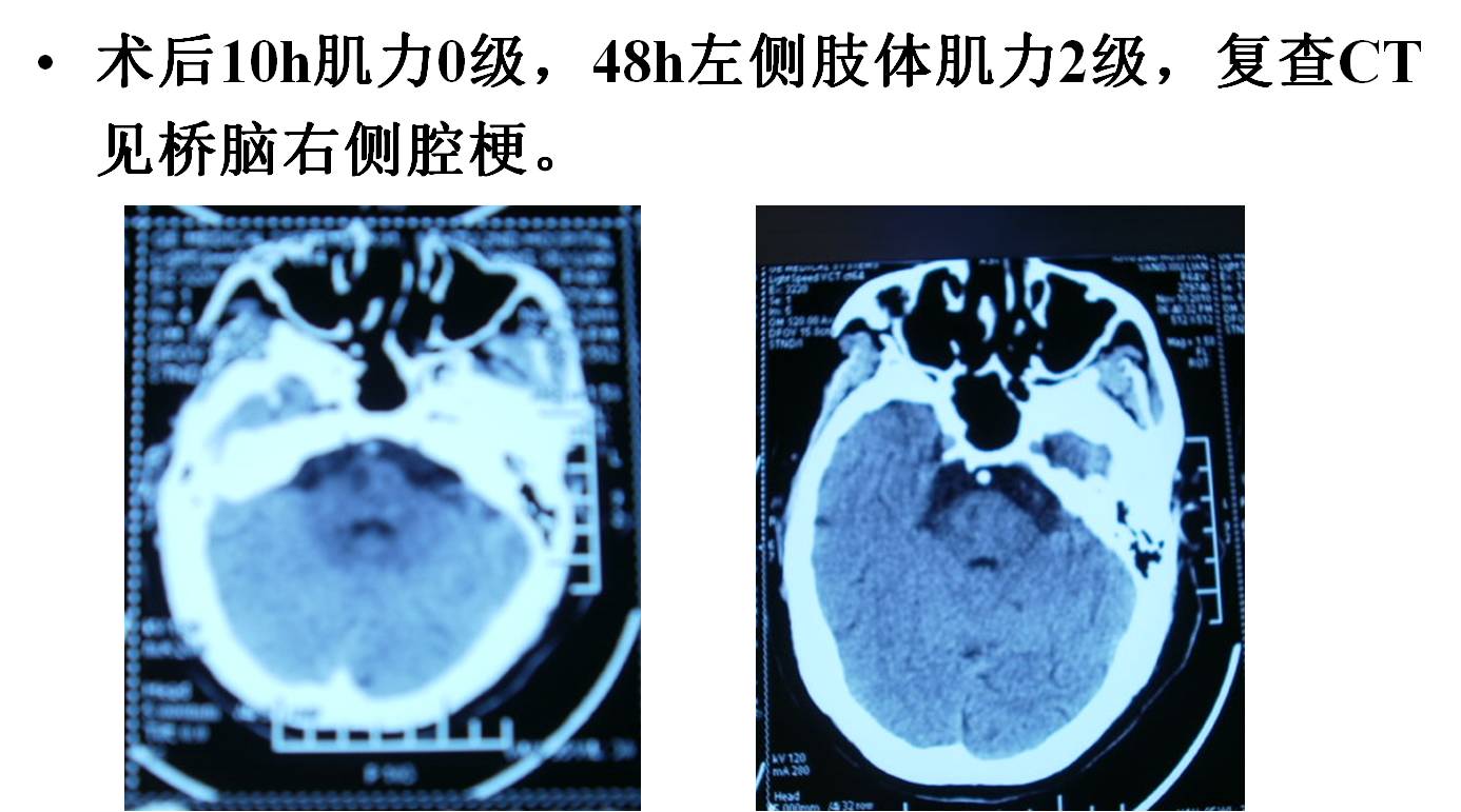 介入科病例,介入手术的健康科普方案