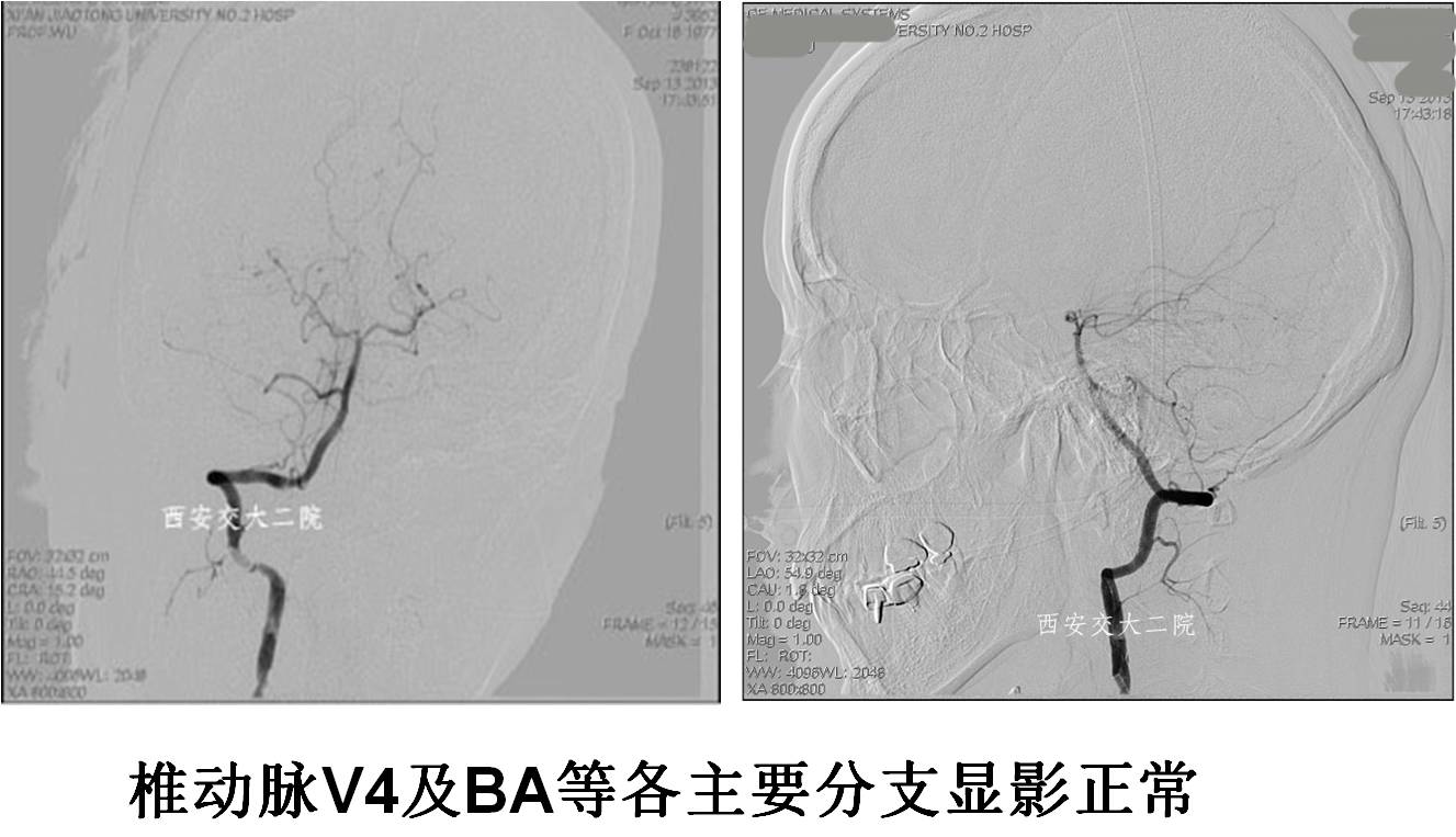 介入科病例,介入手术的健康科普方案
