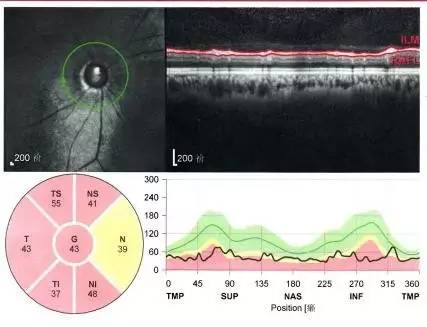 中医治疗正常眼压开角型青光眼,原发性闭角型青光眼快速降眼压