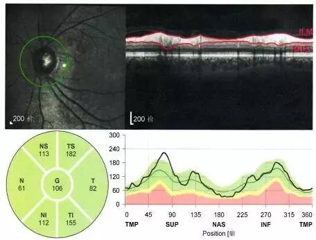 中医治疗正常眼压开角型青光眼,原发性闭角型青光眼快速降眼压