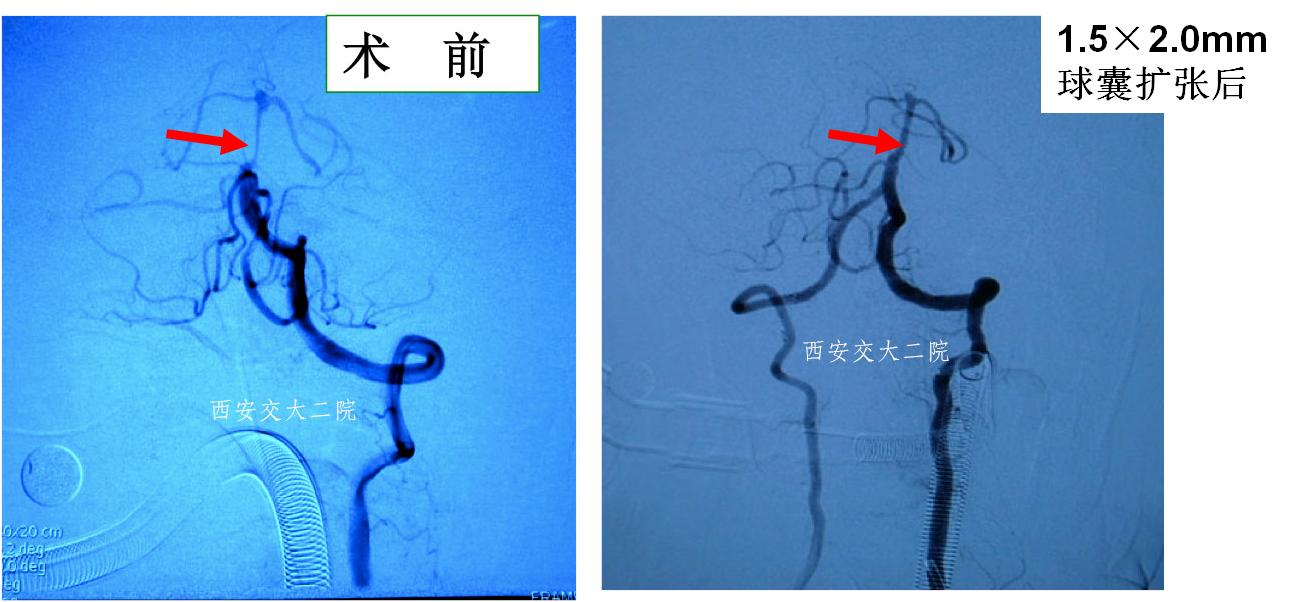 介入科病例,介入手术的健康科普方案