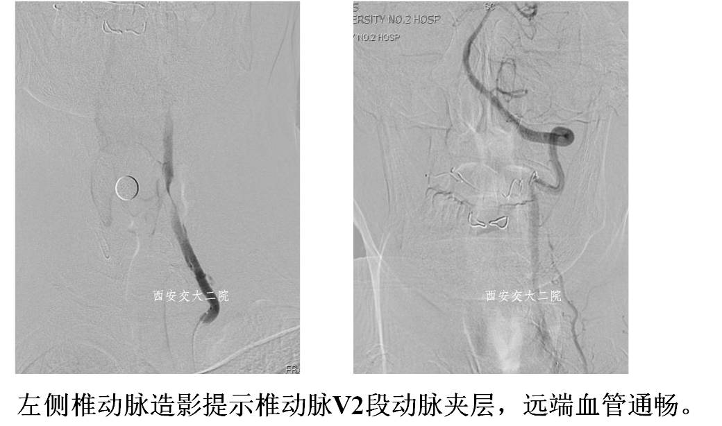 介入科病例,介入手术的健康科普方案