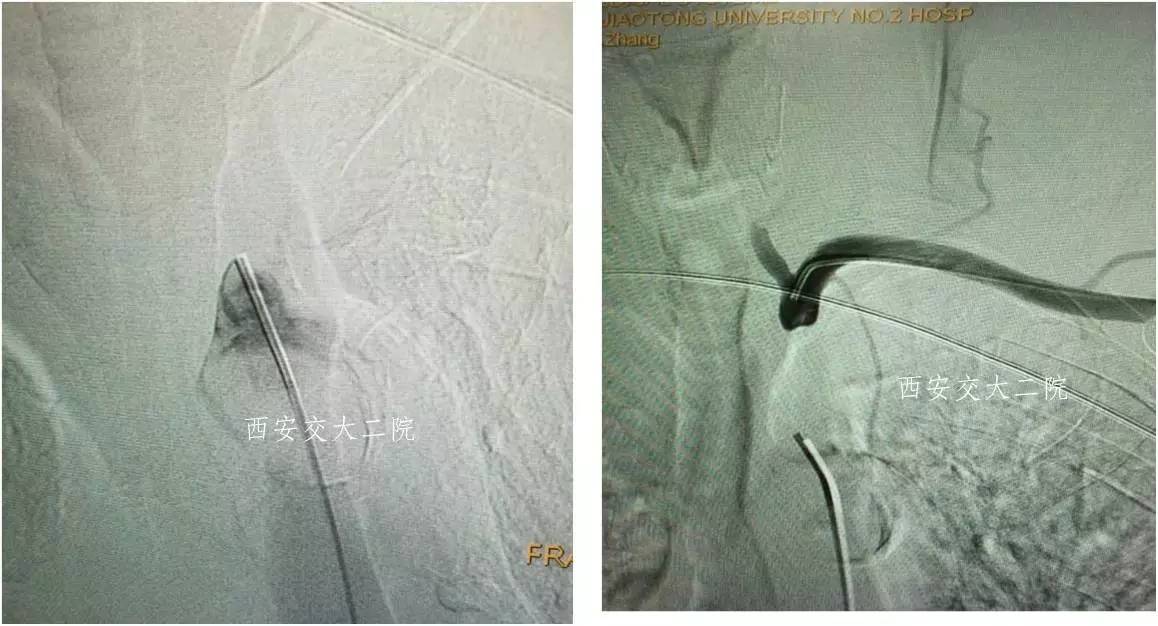 介入科病例,介入手术的健康科普方案