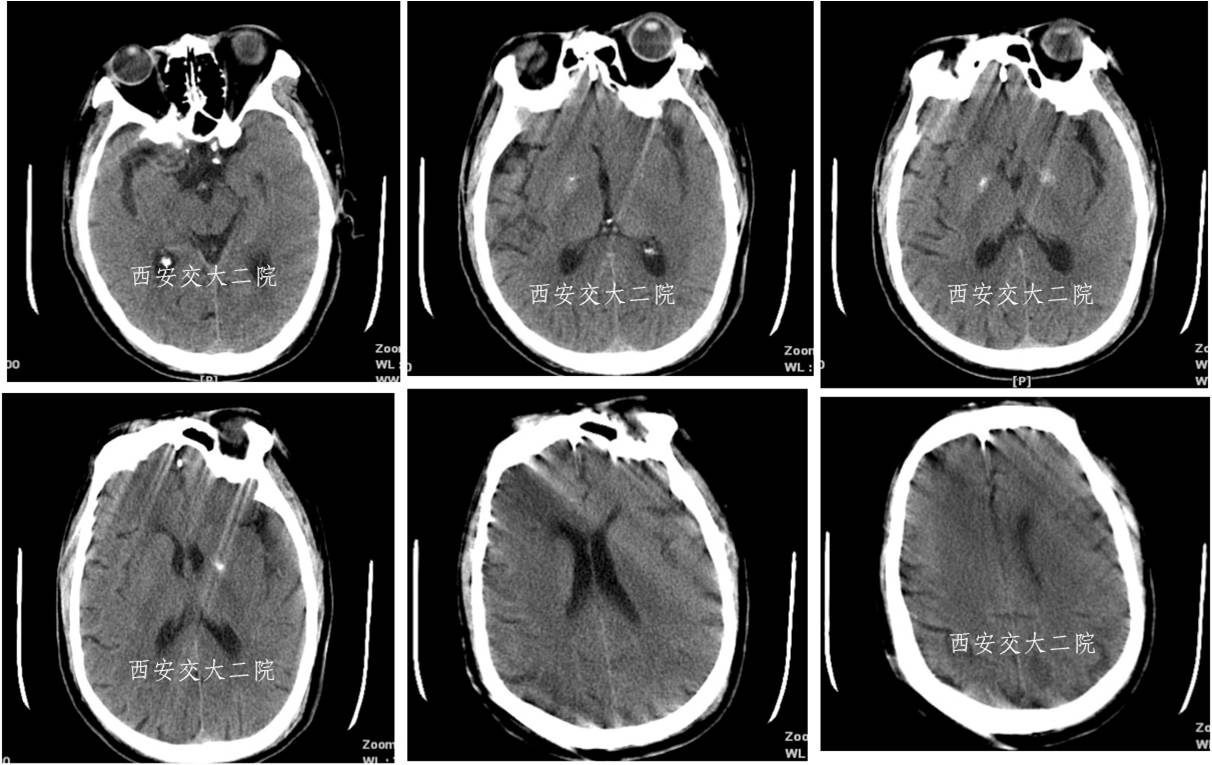 介入科病例,介入手术的健康科普方案