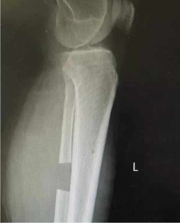 退行性骨关节炎的症状和治疗,退行性骨性关节炎分级