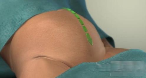 剖腹产的女人请好好珍惜,剖腹产女人要受多少罪