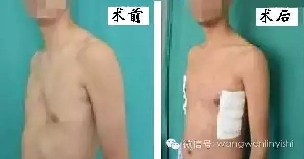 漏斗胸的治疗方法和注意事项,漏斗胸的正确解决方法