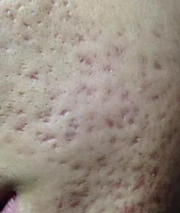 不同类型的痘痘怎么解决,痘痘不同阶段