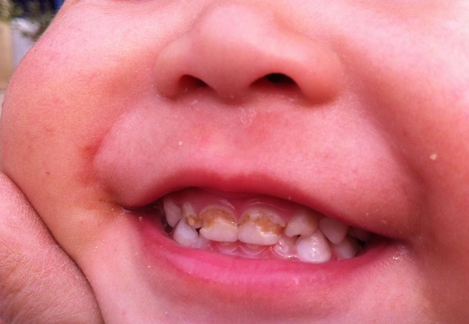 孩子牙齿烂根不掉新牙出来怎么办,小孩4岁多满口的烂牙怎么办