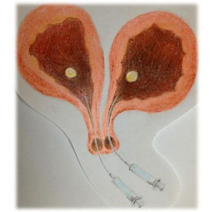 双子宫孕妈产子命悬一线,产检多次医生竟未查出异常