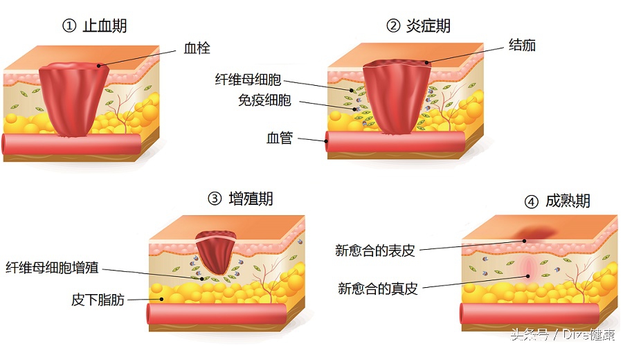 如何防止疤痕形成的小妙招,如何避免疤痕留印