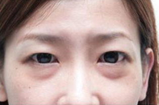 眼袋和卧蚕你还傻傻分不清楚吗,一张图告诉你卧蚕和眼袋的区别