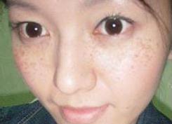 色斑和色素有什么区别,色斑和色斑区别