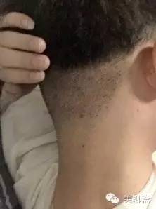 植发际线的亲身体验,亲身体验植发经历