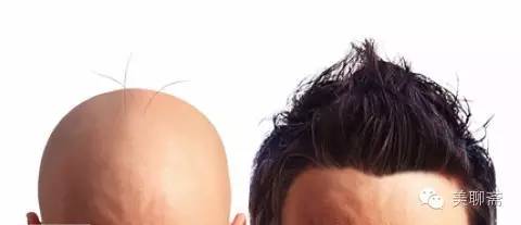 植发际线的亲身体验,亲身体验植发经历