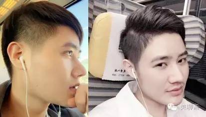 植发际线的亲身体验,亲身体验植发经历