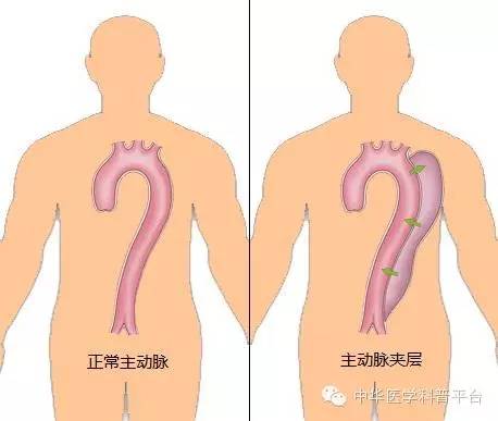 主动脉夹层疼痛位置,主动脉夹层什么症状