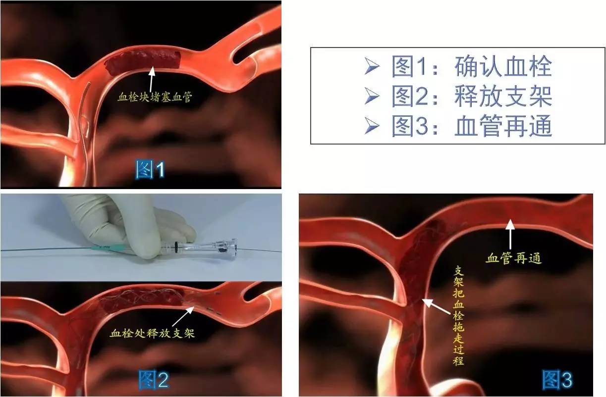 介入医学手术类视频,颈动脉介入手术病例分享