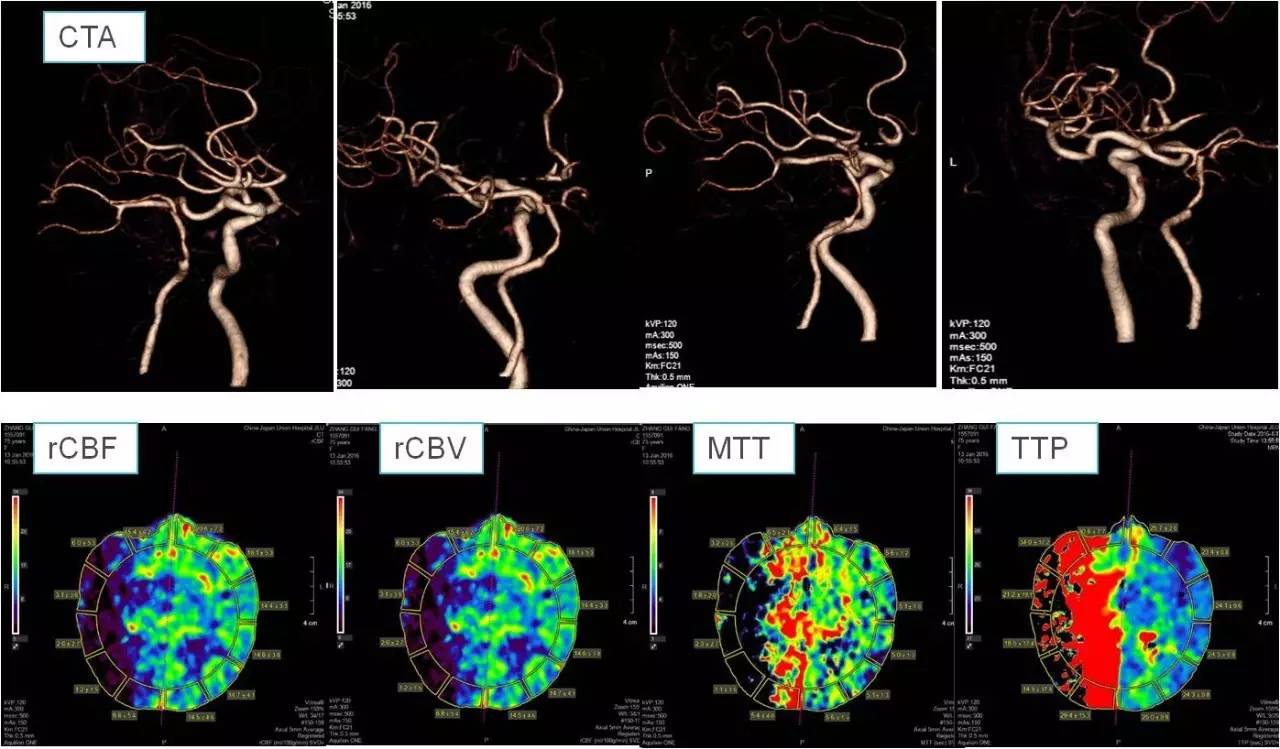 介入医学手术类视频,颈动脉介入手术病例分享