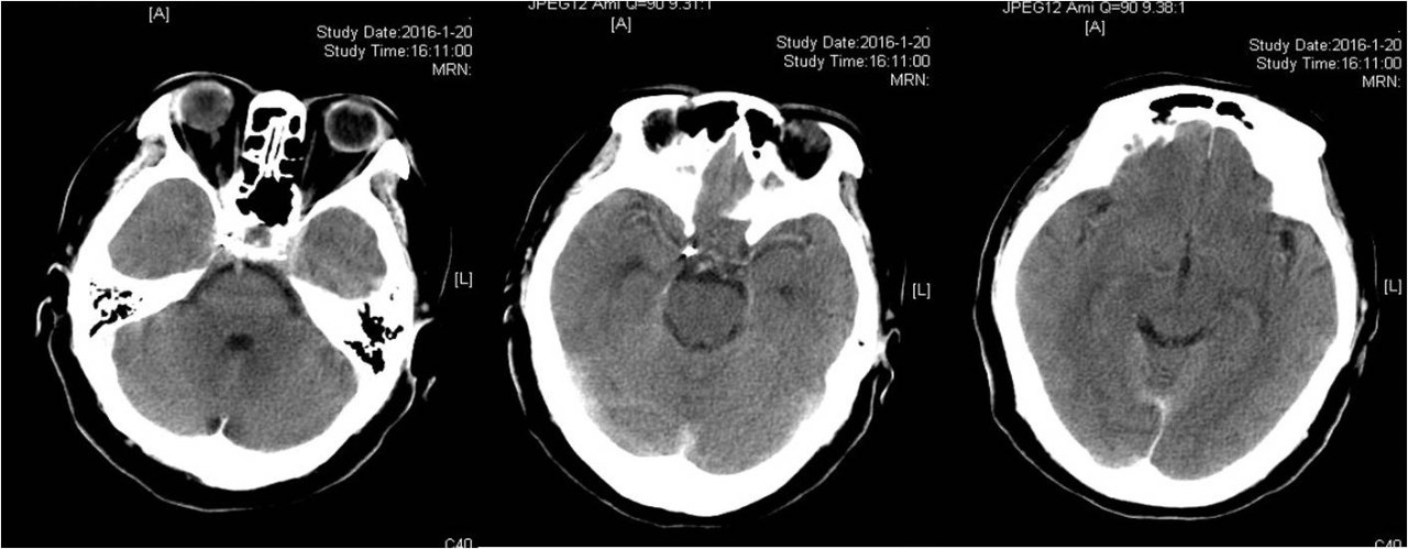 介入医学手术类视频,颈动脉介入手术病例分享