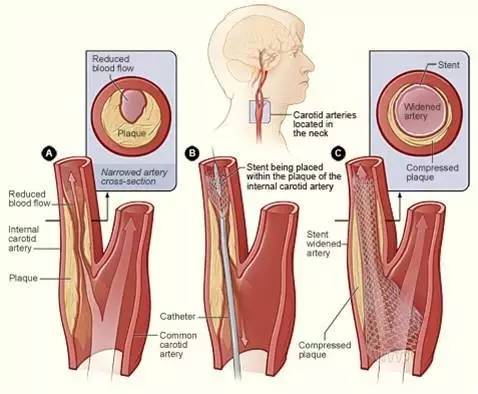 介入医学手术类视频,颈动脉介入手术病例分享