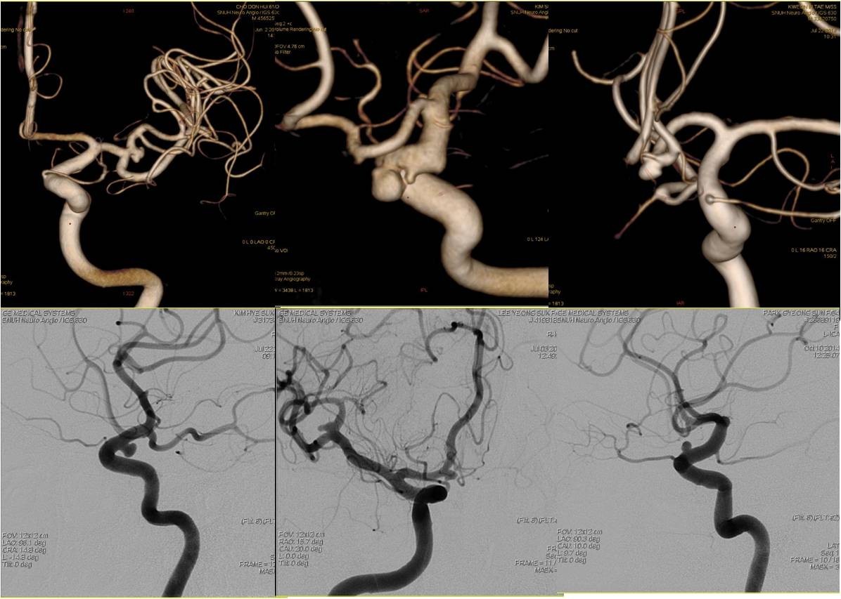 介入医学手术类视频,颈动脉介入手术病例分享