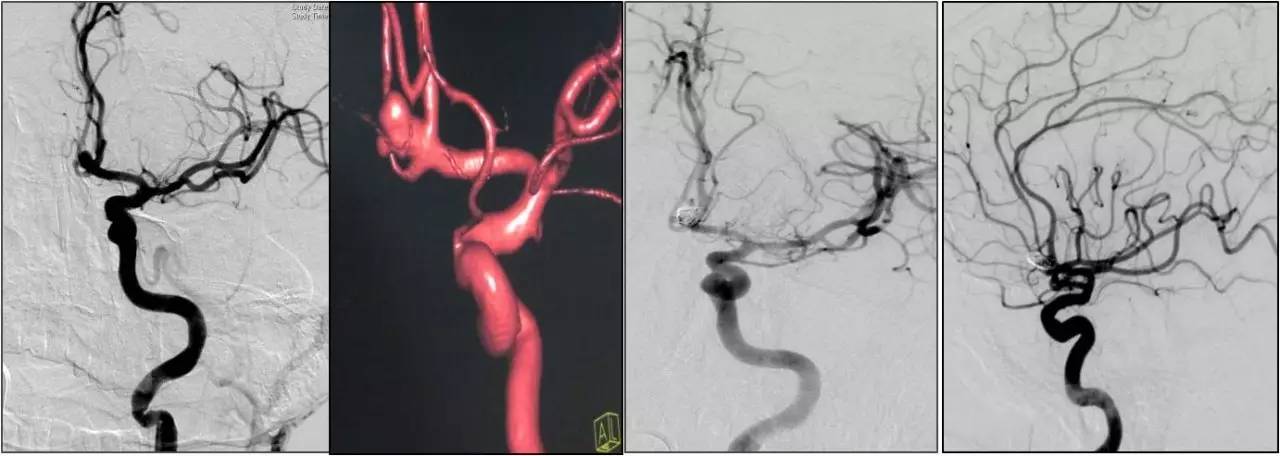 介入医学手术类视频,颈动脉介入手术病例分享