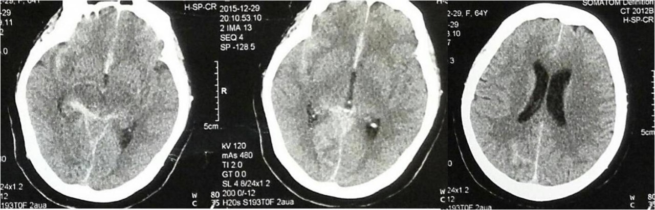 介入医学手术类视频,颈动脉介入手术病例分享