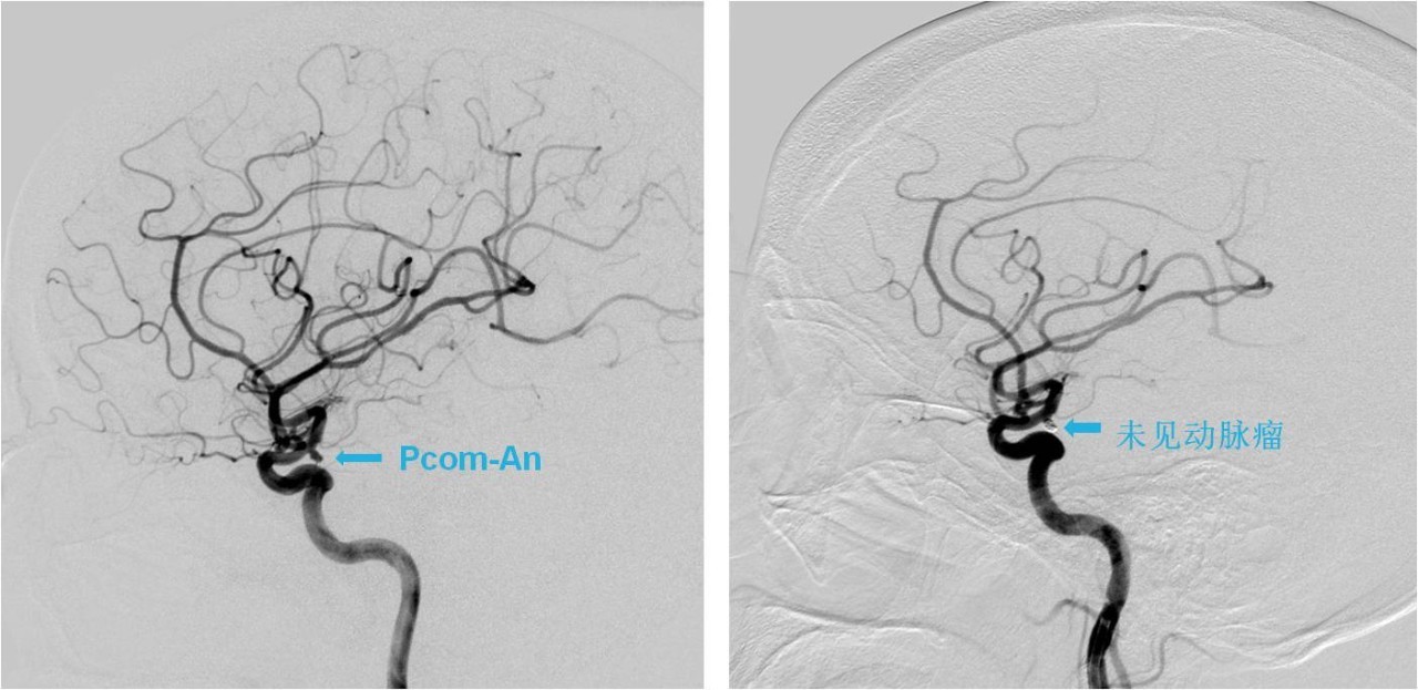 介入医学手术类视频,颈动脉介入手术病例分享