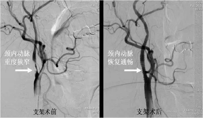 介入医学手术类视频,颈动脉介入手术病例分享