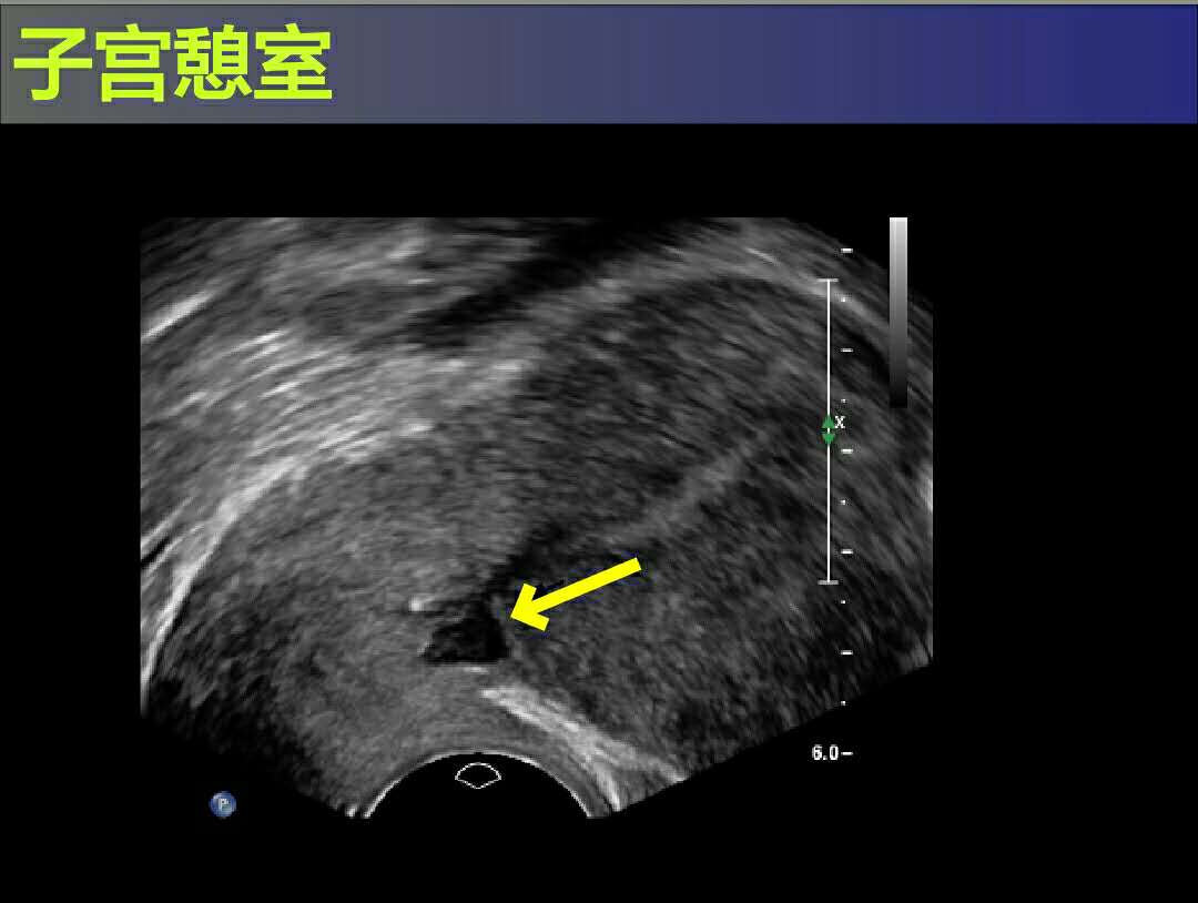 剖宫产术后——子宫多了个“小阁楼”?
