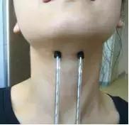 周惠嫦主任:鼻咽癌放疗后吞咽康复治疗的方法