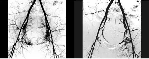 围绝经期异常子宫出血的治疗首选,女性异常子宫出血的护理问题