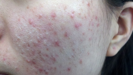 长水痘什么东西不能吃,长水痘能不能吃鸡蛋