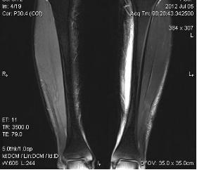 肩周炎中频电疗处方,颈椎病理疗中频电疗